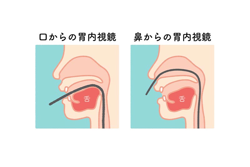 経鼻内視鏡による負担の少ない検査