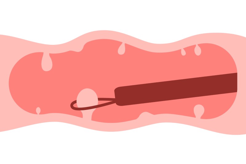 日帰りでのポリープ切除に対応