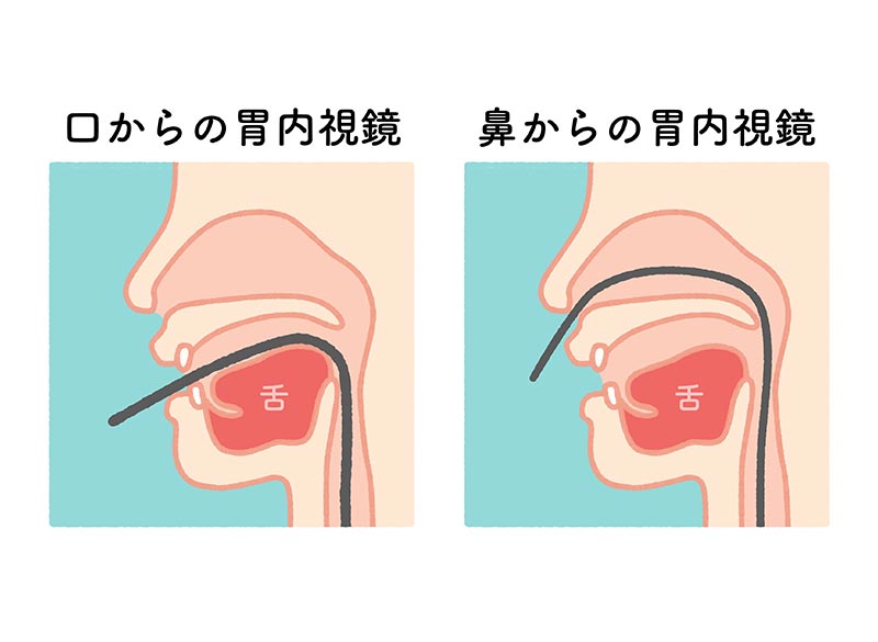 経鼻内視鏡検査